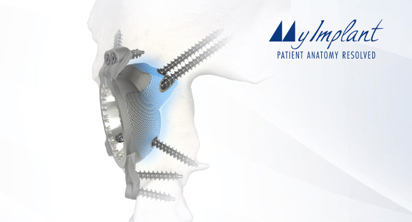 Medacta Extends MyImplant Platform to Complex Hip Reconstruction